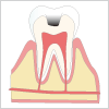 象牙質のむし歯（C2）