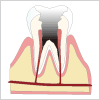 歯根のむし歯（C4）