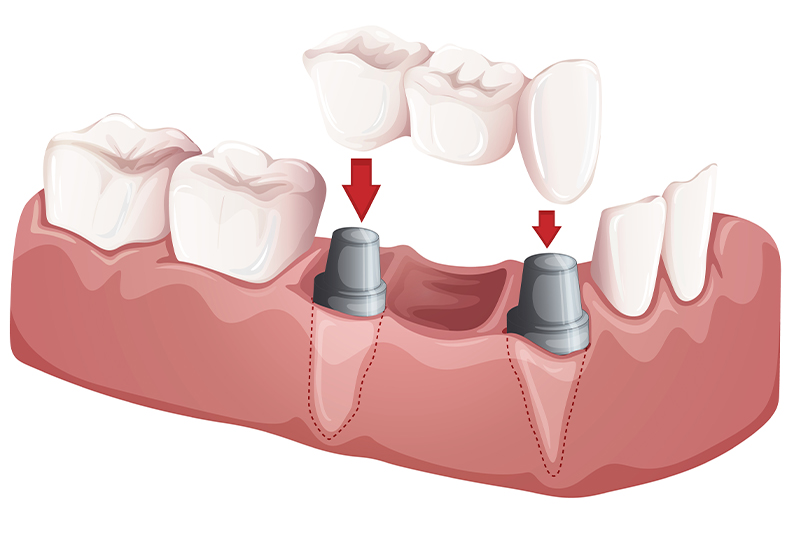欠損治療の選択肢/ブリッジ