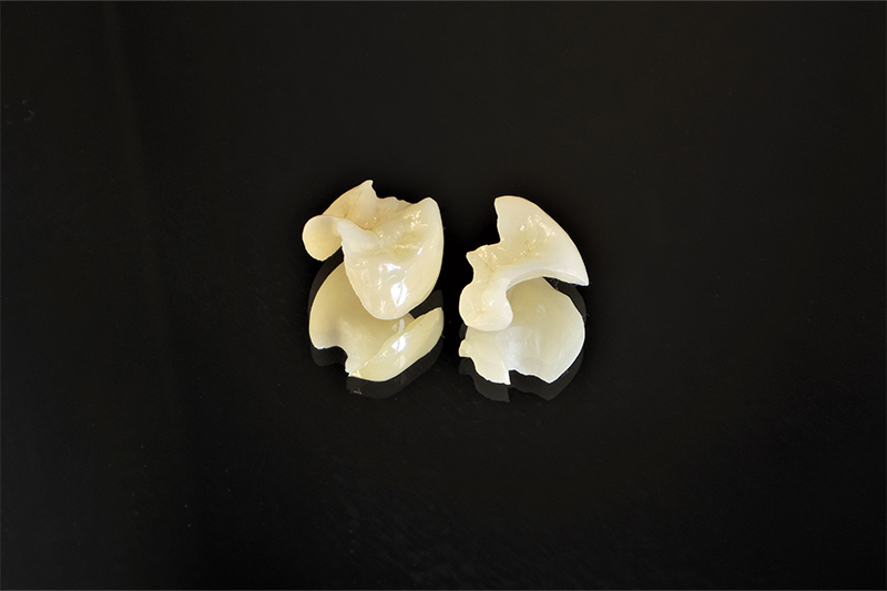 歯が欠ける主な原因/コンポジットレジン修復