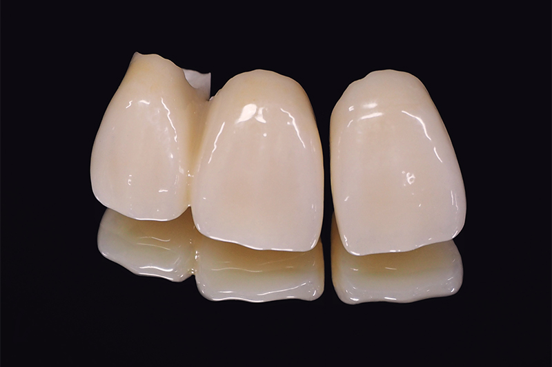 歯が欠ける主な原因/クラウン（被せ物）