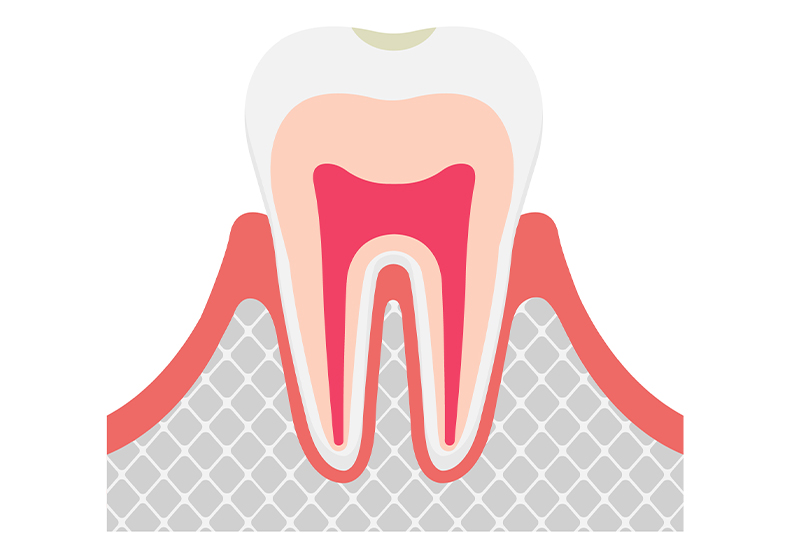 虫歯の進行段階と治療法/C0（初期虫歯）