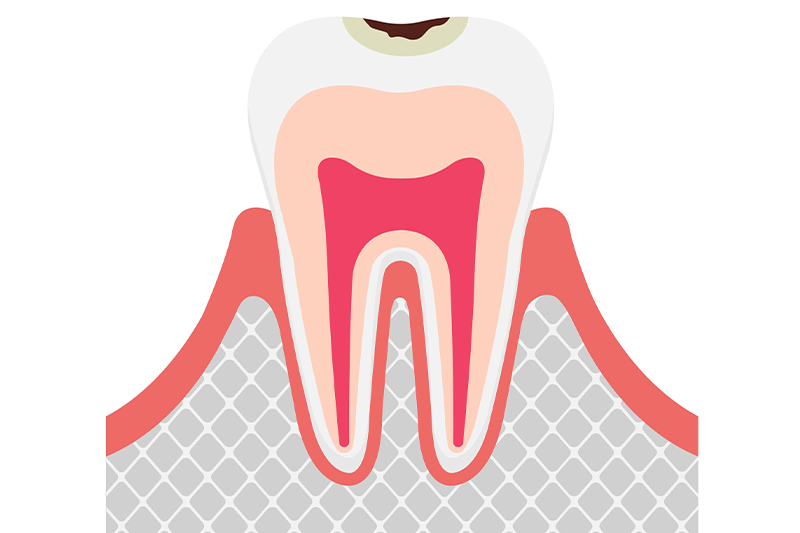 虫歯の進行段階と治療法/C1（エナメル質の虫歯）