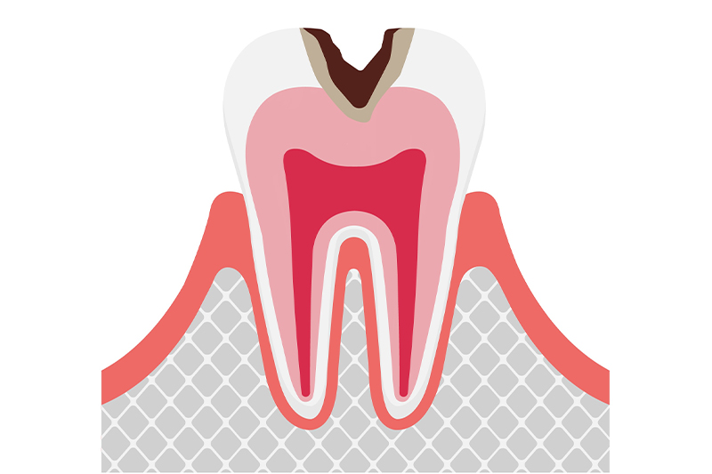 虫歯の進行段階と治療法/C2（象牙質の虫歯）
